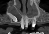 Maxillary cyst